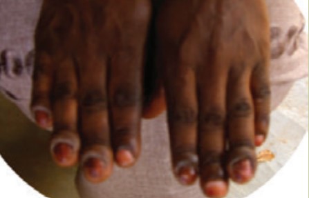 Nail Fungus
